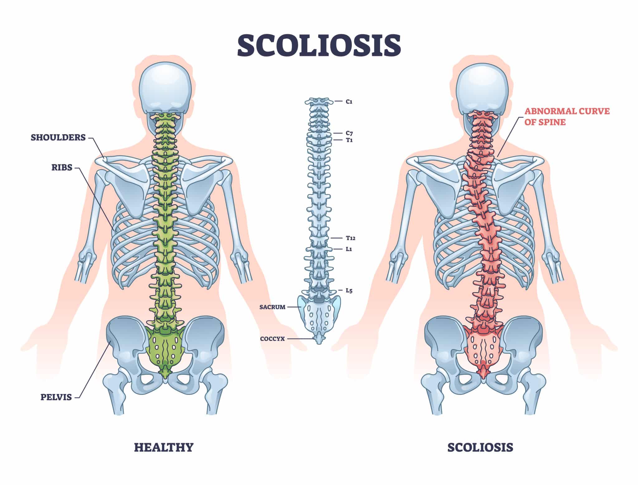 diagram of scoliosis