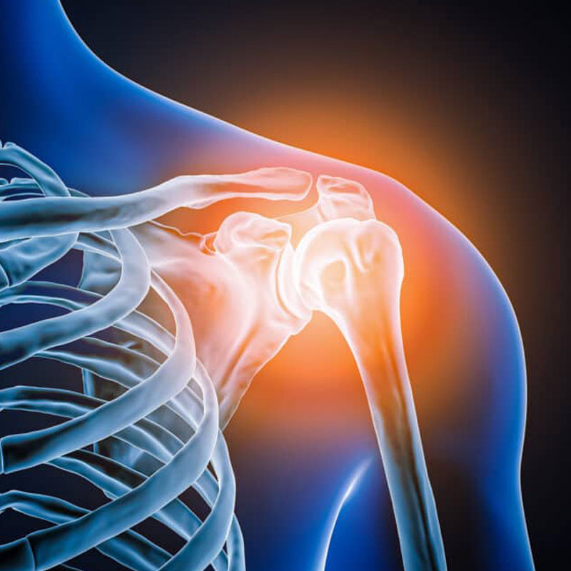 diagram of shoulder labral tear