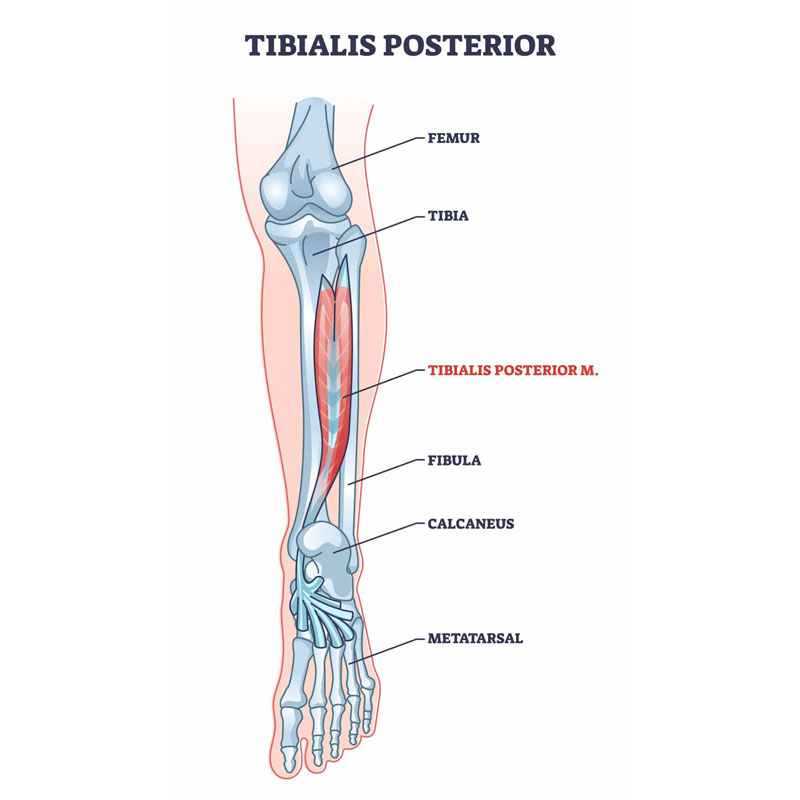 diagram of tibialis posterior tendinopathy
