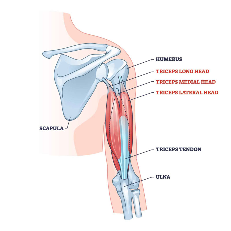 diagram of tricep tendinopathy