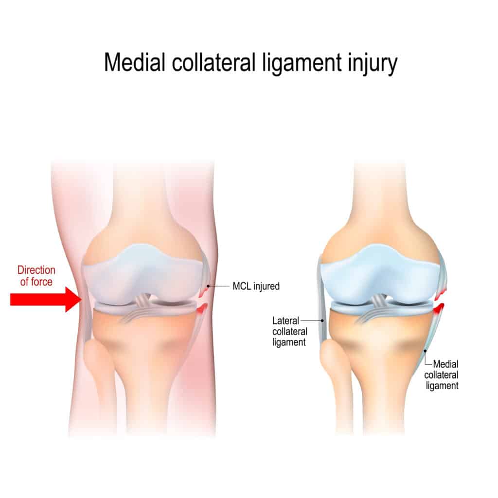 graphic depicting an mcl sprain