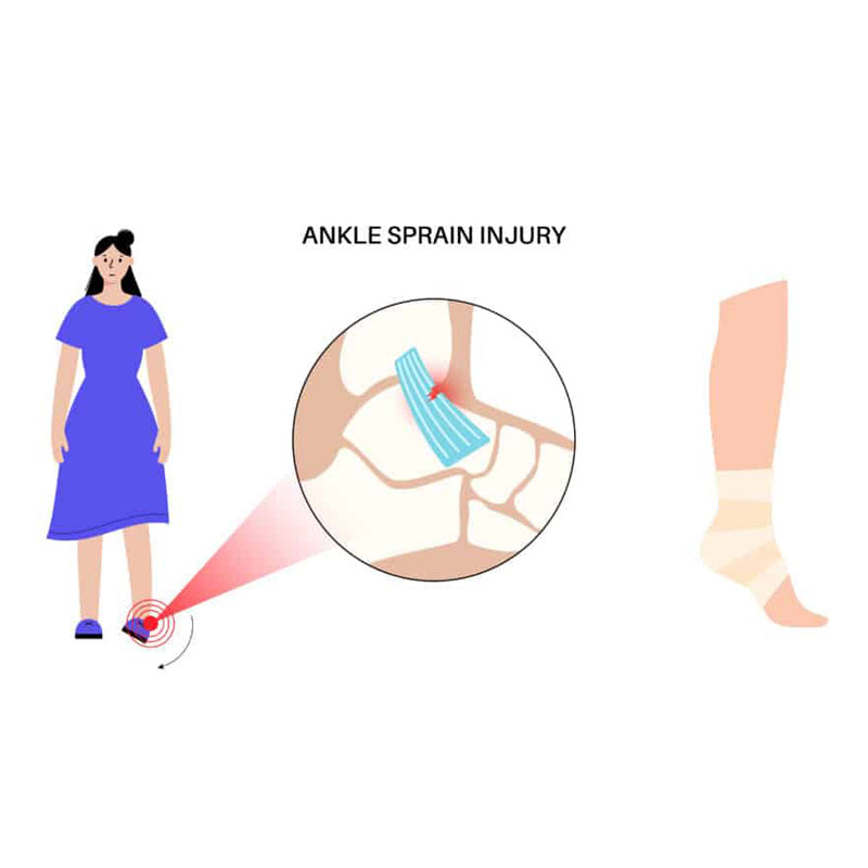 diagram of a lateral ankle sprain