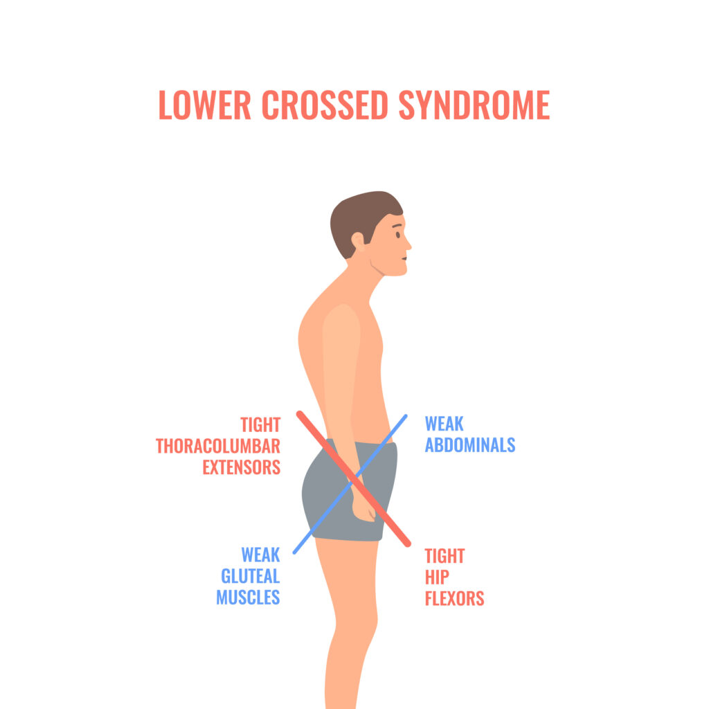 diagram of lower cross postural imbalances