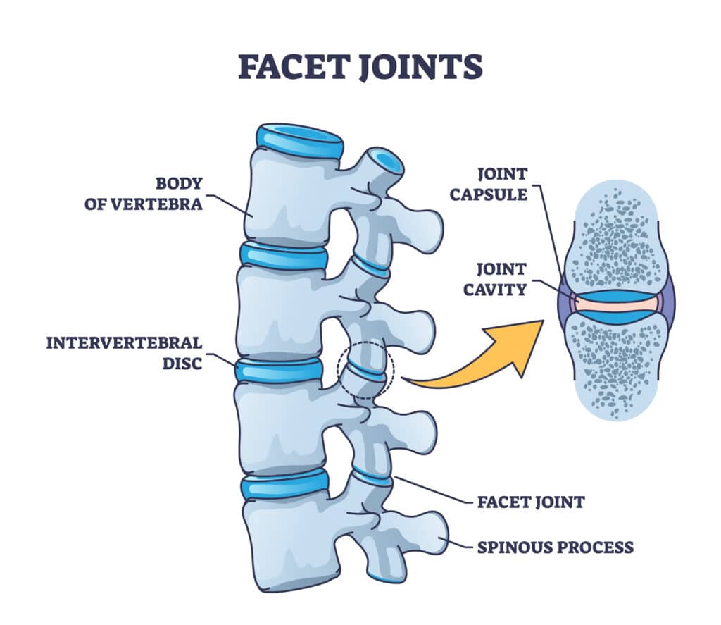 diagram of lumbar facet joint arthrosis