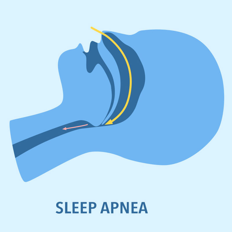 diagram of obstructive sleep apnea