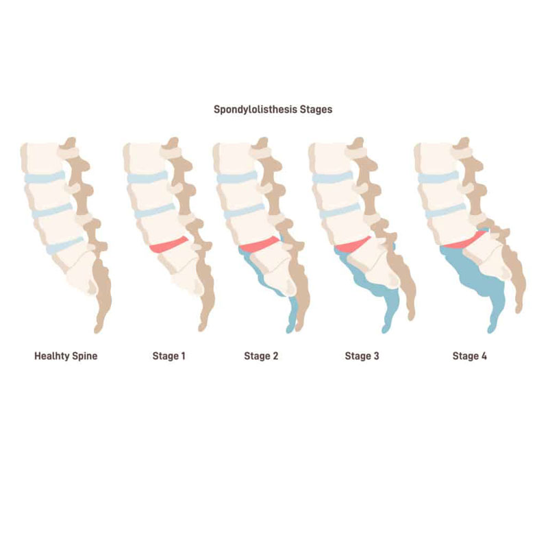 spondylolisthesis diagram