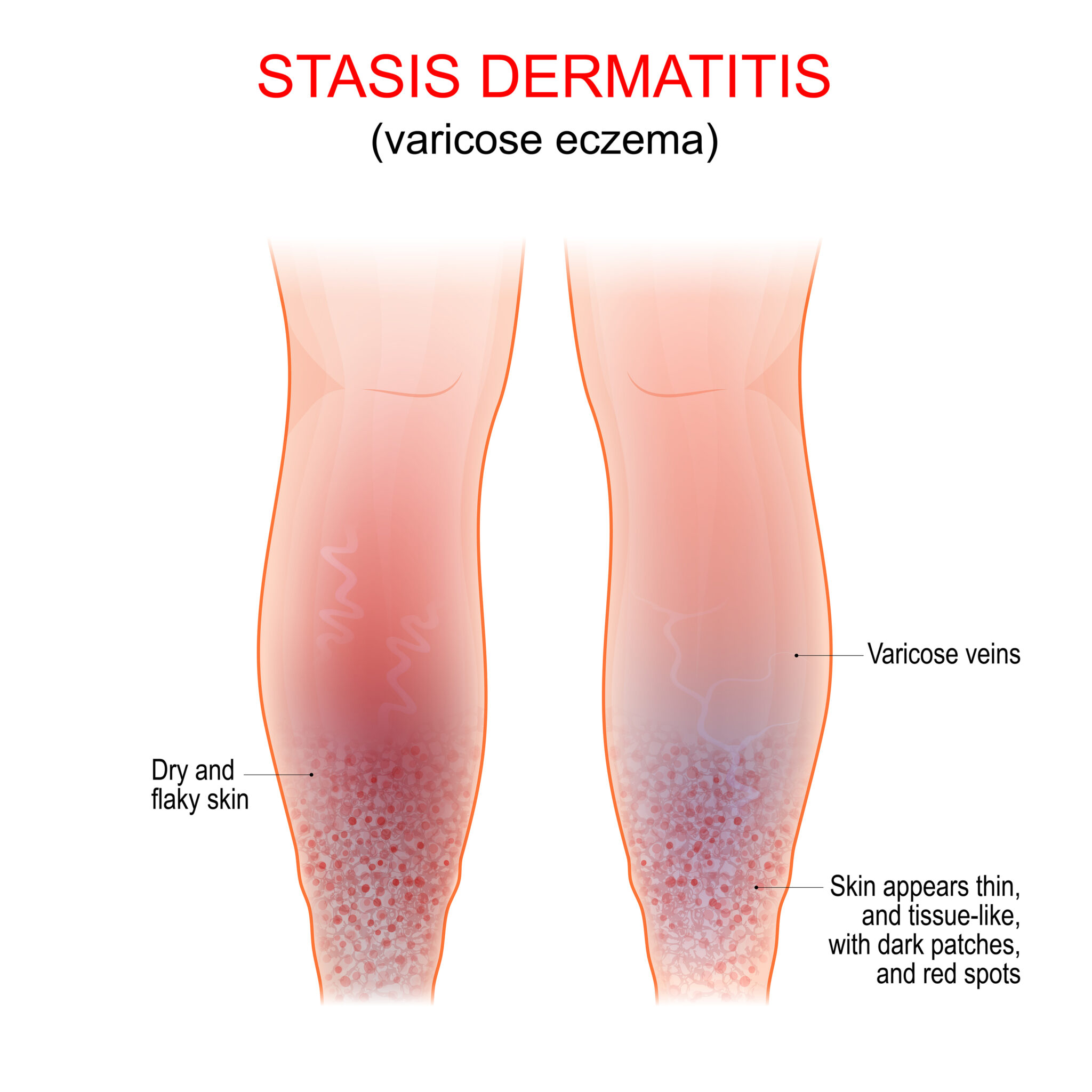 diagram of stasis dermatitis