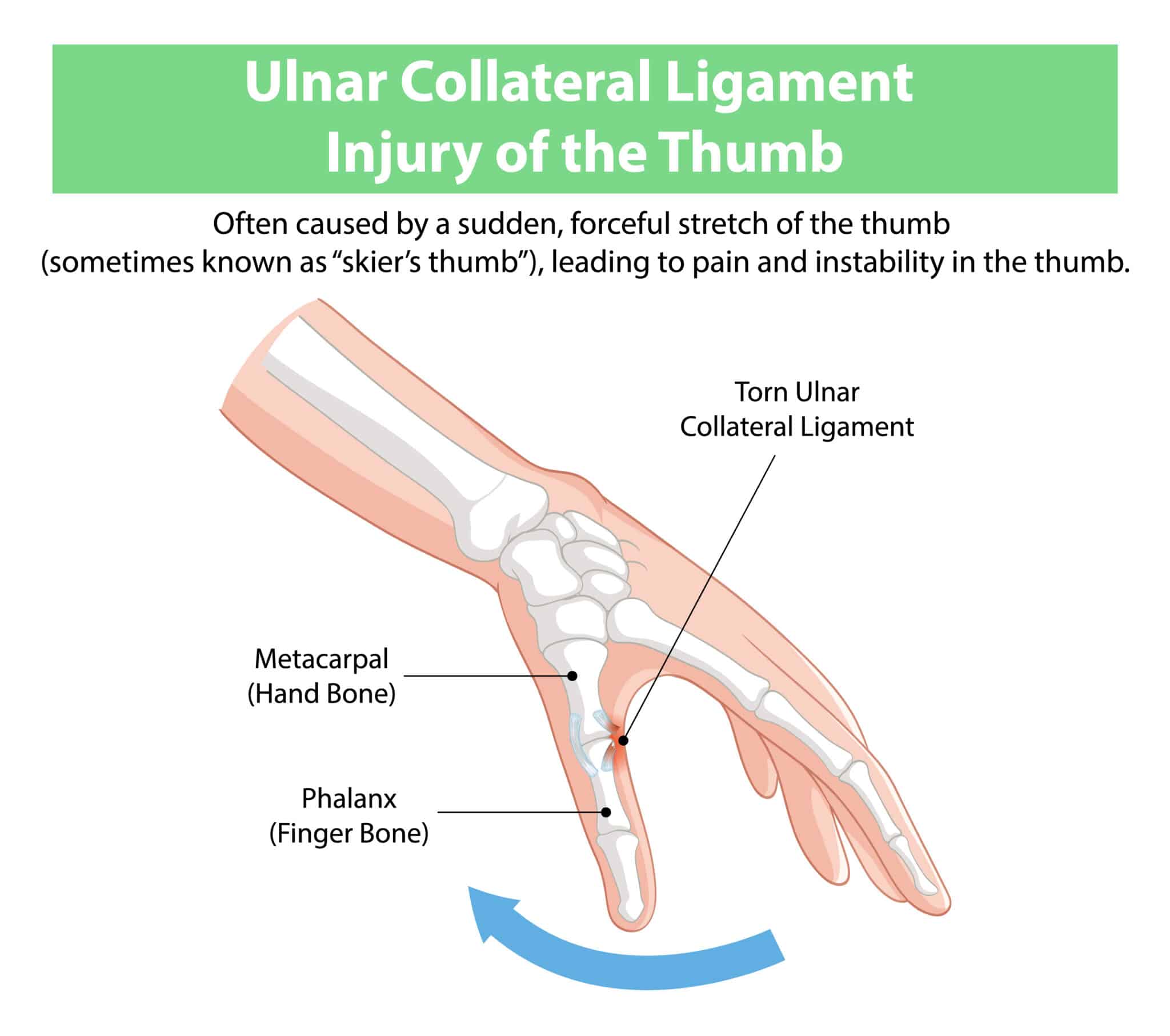 thumb ucl sprain diagram