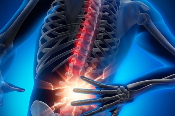 3D Rendering - Starke Schmerzen in der Wirbelsäule und Bandscheiben - Bandscheibenvorfall