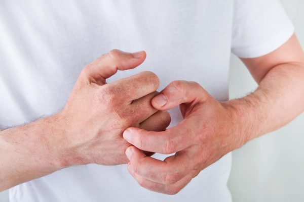 What Triggers Eczema?