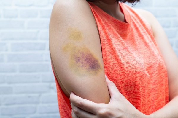 causes of contusions